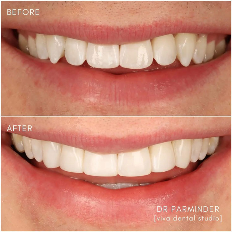 before and after