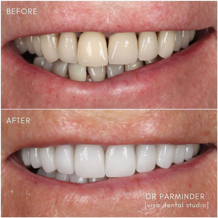 before and after