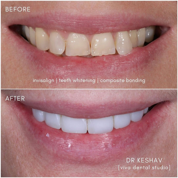 before and after