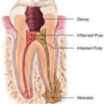 Root Canal treatment Dentist Viva Dental Studio Hornchurch Essex