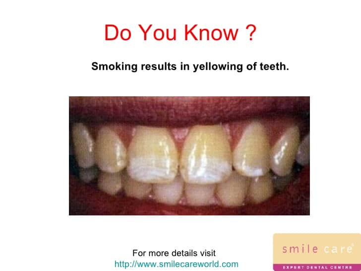 Smoking effects on teeth dentist Hornchurch Essex Viva Dental Studio